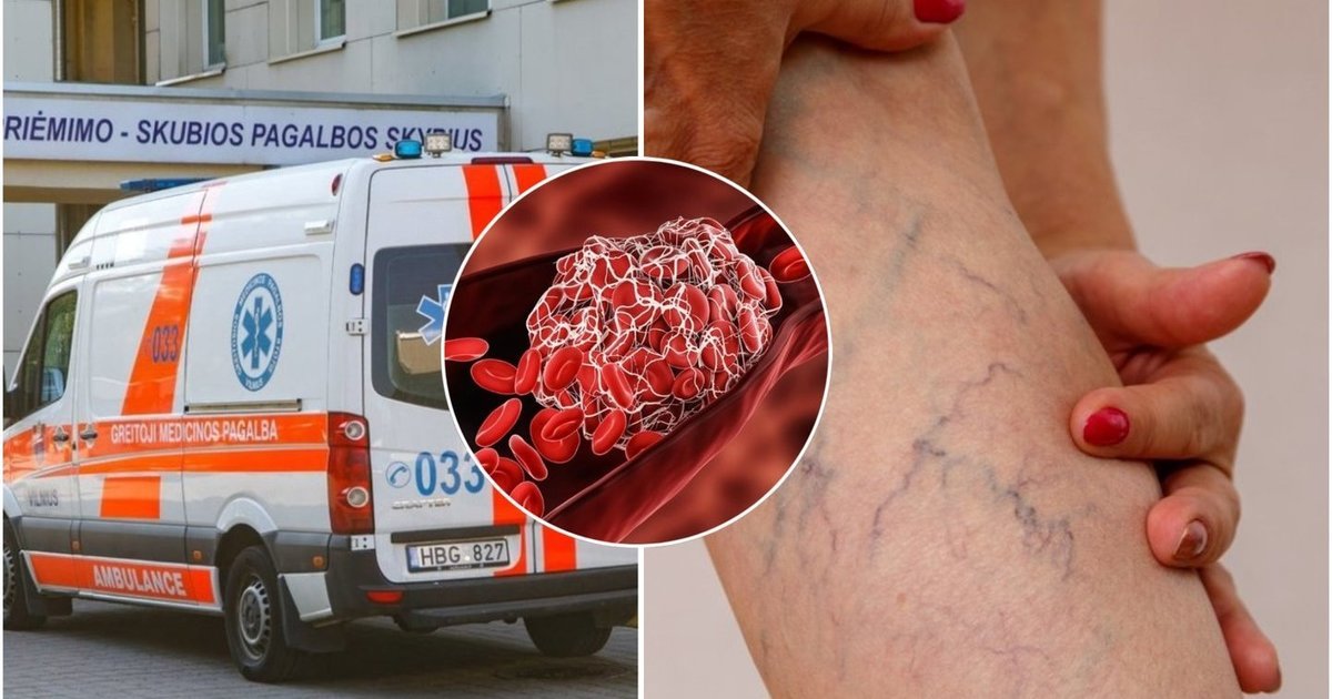 Išsiplėtusios kojų venos – ne vien grožio problema: kada būtina sunerimti ir kaip sau padėti
