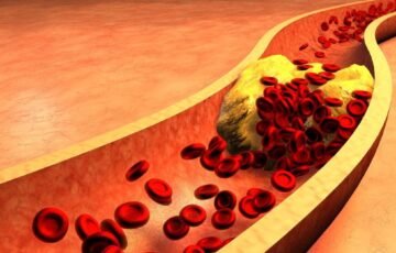 Cinamonas gali paveikti cholesterolį: ką rodo 15 klinikinių tyrimų