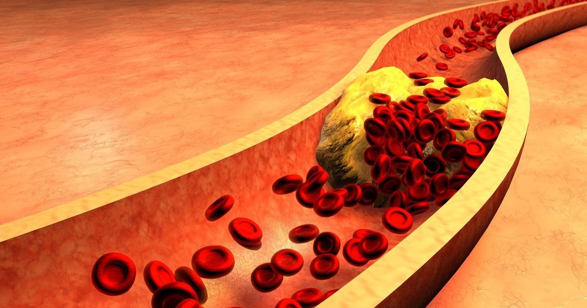 Cinamonas gali paveikti cholesterolį: ką rodo 15 klinikinių tyrimų