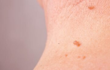Dariniai „ant kojelės“ kelia nerimą: kada jų šalinti iš tiesų nereikia