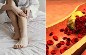 Du pojūčiai kojose gali perspėti apie cholesterolį: ignoruojant gresia itin sunki komplikacija
