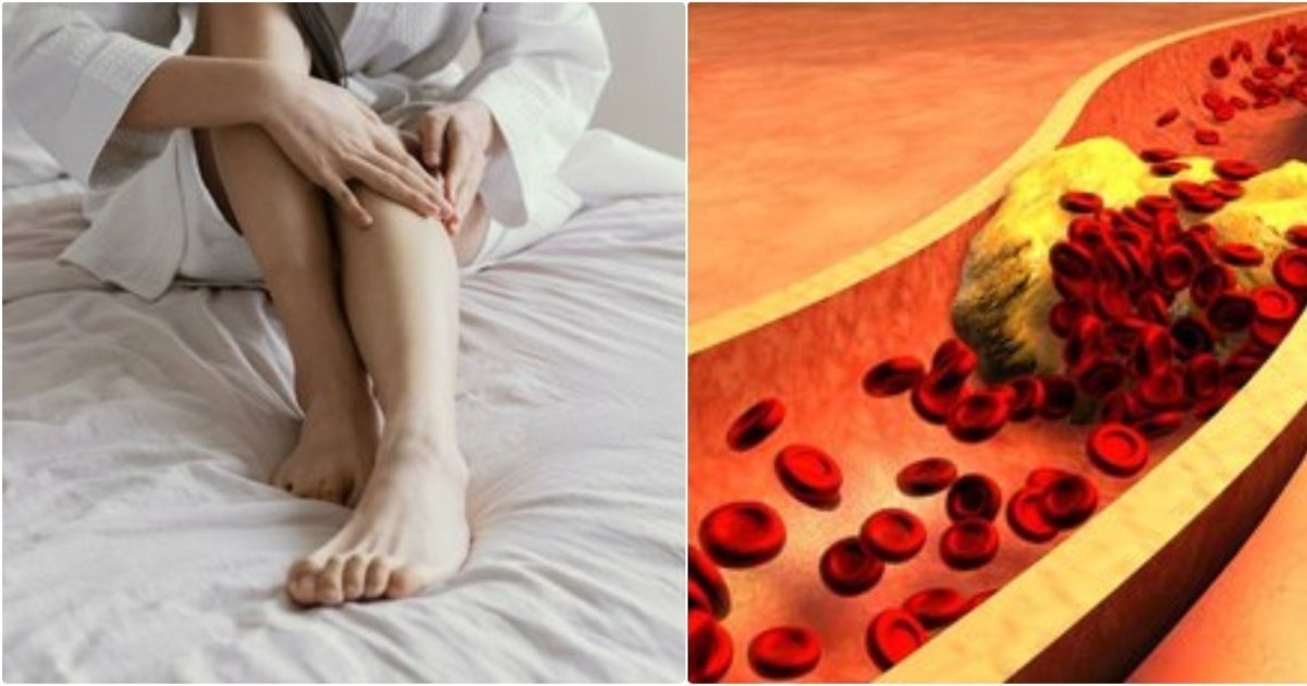 Du pojūčiai kojose gali perspėti apie cholesterolį: ignoruojant gresia itin sunki komplikacija